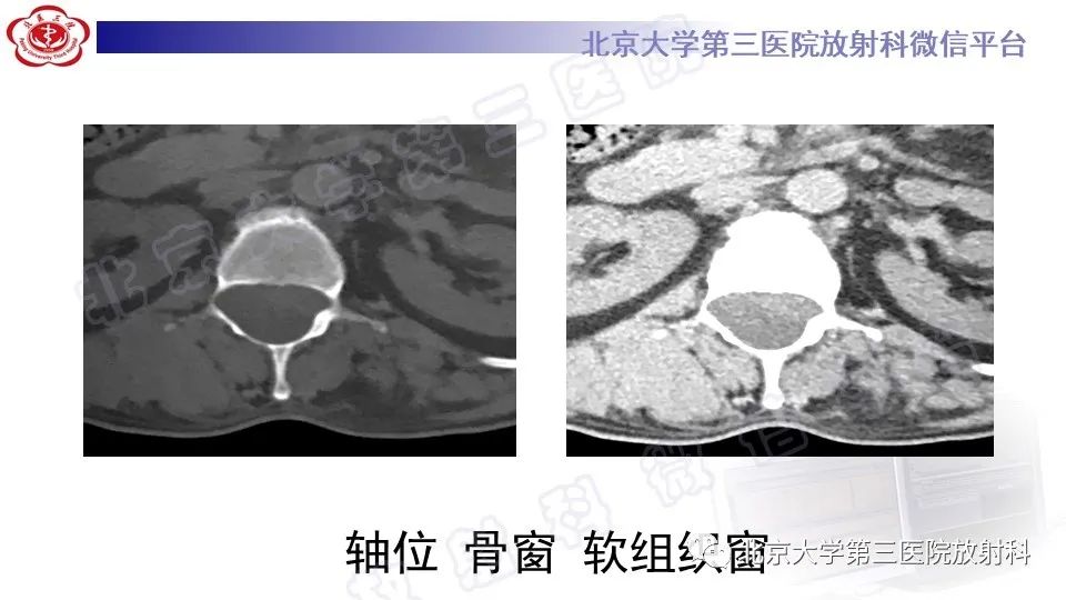【PPT】椎管内脊膜囊肿-3