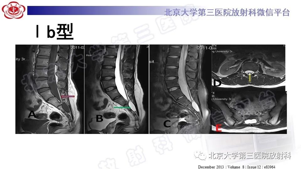【PPT】椎管内脊膜囊肿-26