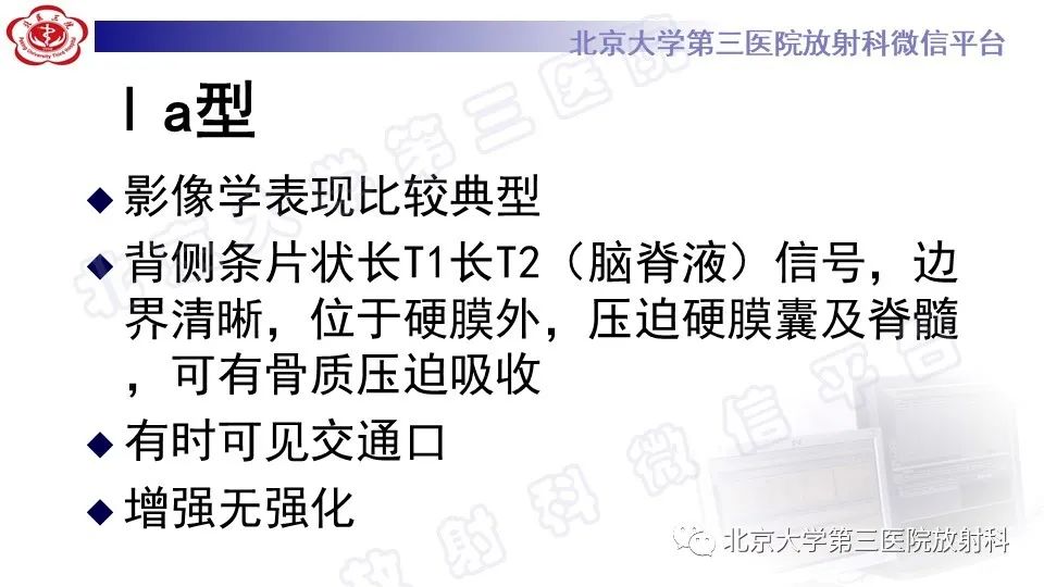 【PPT】椎管内脊膜囊肿-21