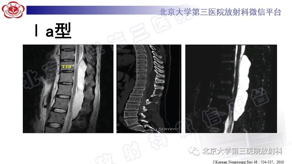 【PPT】椎管内脊膜囊肿-23