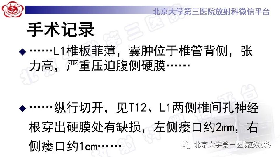 【PPT】椎管内脊膜囊肿-12