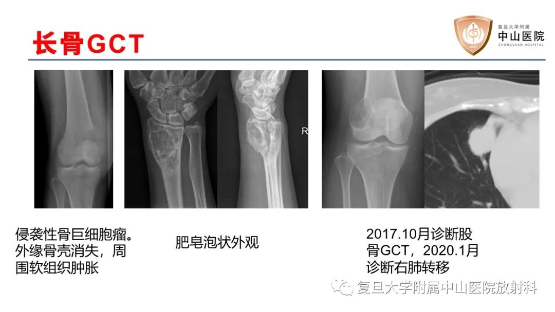 【病例】脊柱骨巨细胞瘤1例CT及MR影像-28