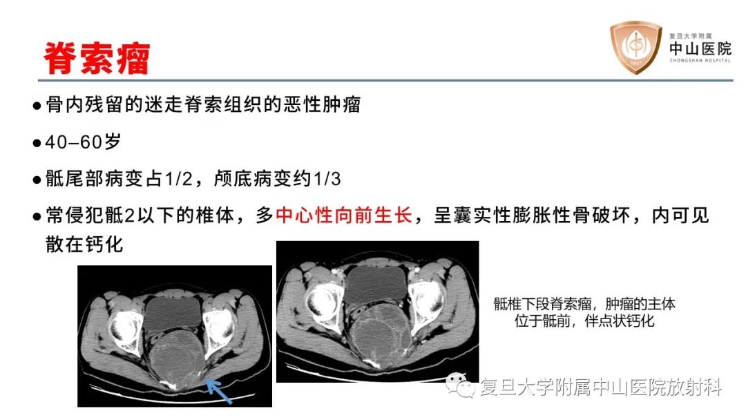 【病例】脊柱骨巨细胞瘤1例CT及MR影像-20