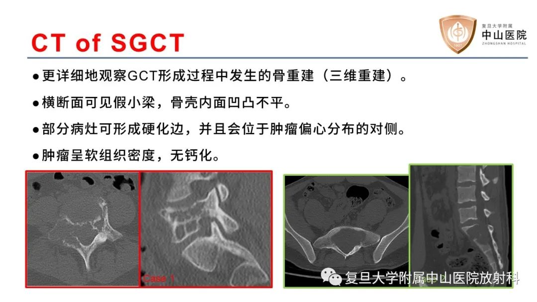 【病例】脊柱骨巨细胞瘤1例CT及MR影像-14