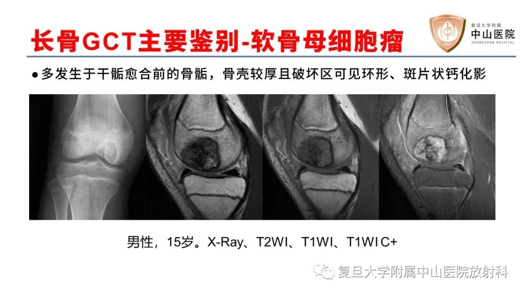 【病例】脊柱骨巨细胞瘤1例CT及MR影像-31