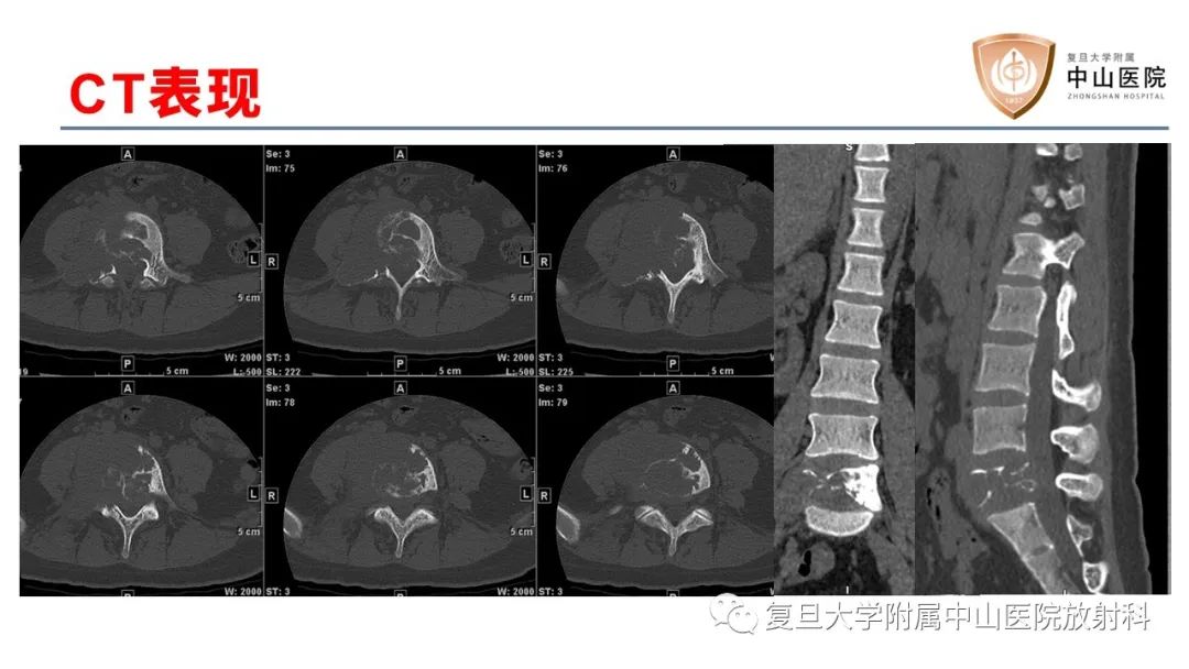 【病例】脊柱骨巨细胞瘤1例CT及MR影像-4