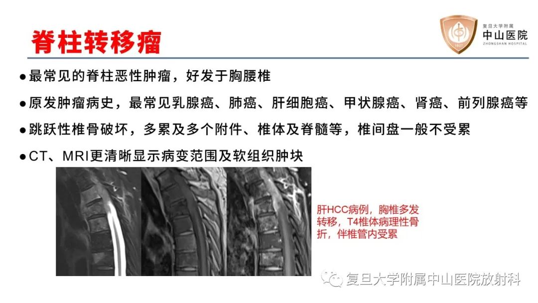 【病例】脊柱骨巨细胞瘤1例CT及MR影像-24