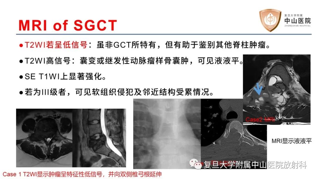 【病例】脊柱骨巨细胞瘤1例CT及MR影像-15