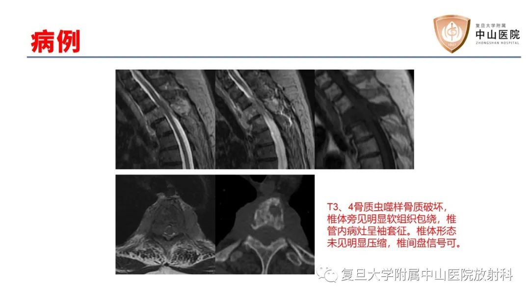 【病例】脊柱骨巨细胞瘤1例CT及MR影像-26