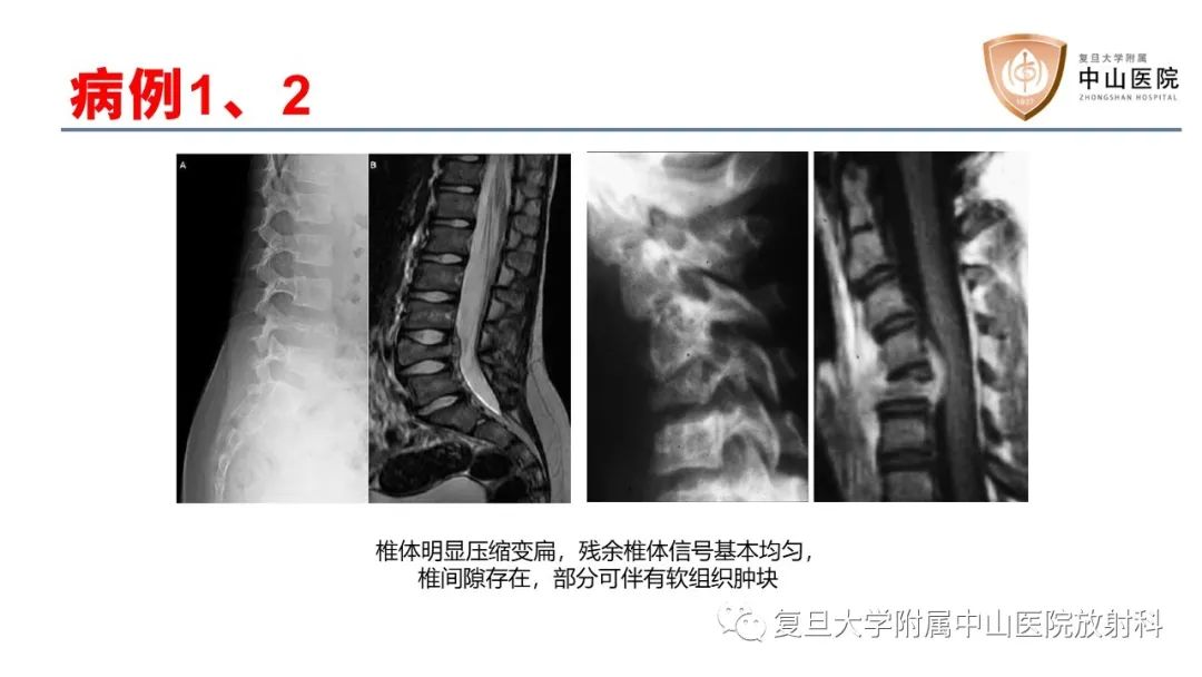 【病例】脊柱骨巨细胞瘤1例CT及MR影像-19