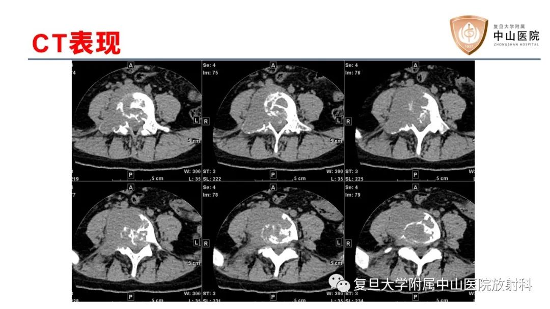 【病例】脊柱骨巨细胞瘤1例CT及MR影像-3
