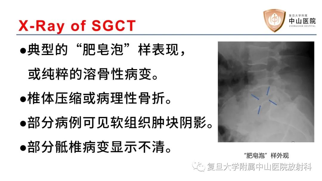 【病例】脊柱骨巨细胞瘤1例CT及MR影像-13