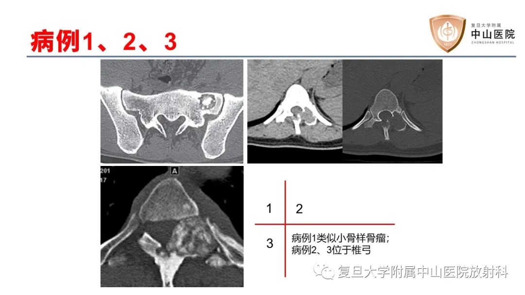 【病例】脊柱骨巨细胞瘤1例CT及MR影像-22