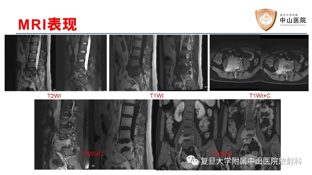 【病例】脊柱骨巨细胞瘤1例CT及MR影像-5