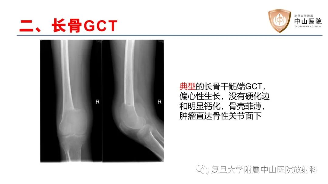 【病例】脊柱骨巨细胞瘤1例CT及MR影像-27