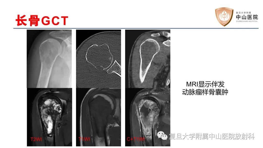 【病例】脊柱骨巨细胞瘤1例CT及MR影像-29