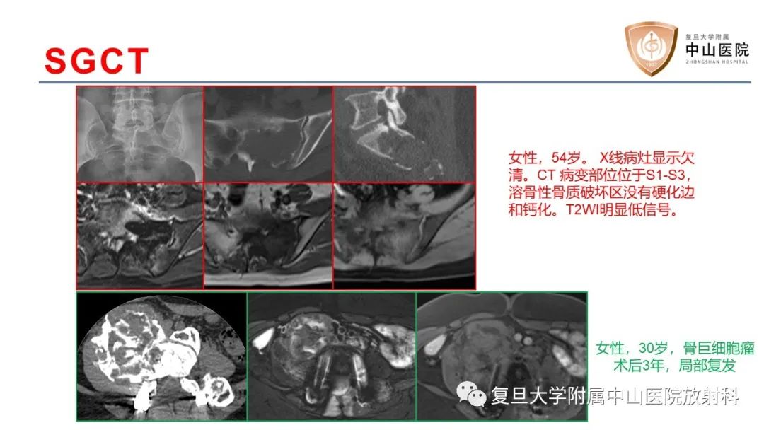 【病例】脊柱骨巨细胞瘤1例CT及MR影像-16