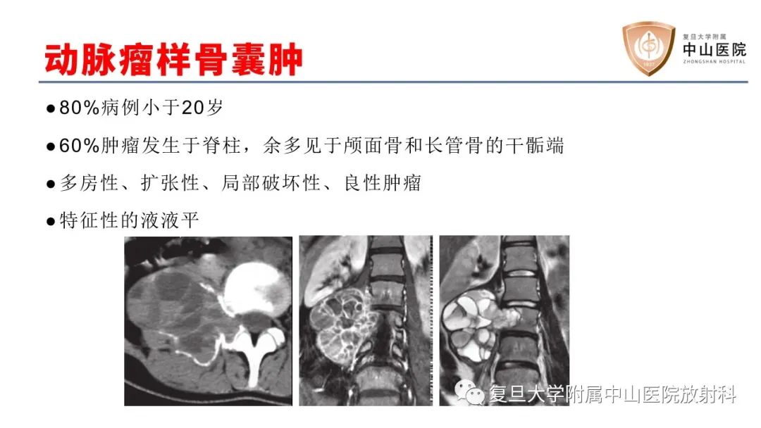 【病例】脊柱骨巨细胞瘤1例CT及MR影像-23