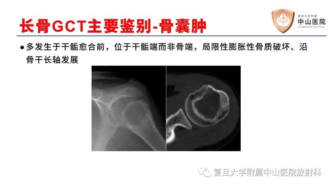 【病例】脊柱骨巨细胞瘤1例CT及MR影像-30