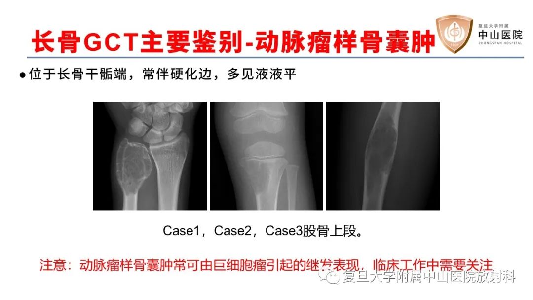 【病例】脊柱骨巨细胞瘤1例CT及MR影像-32
