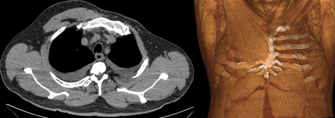 【病例】Poland综合征1例CT影像-2