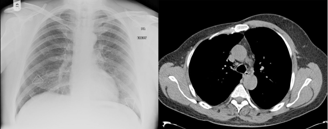 【病例】Poland综合征1例CT影像-5