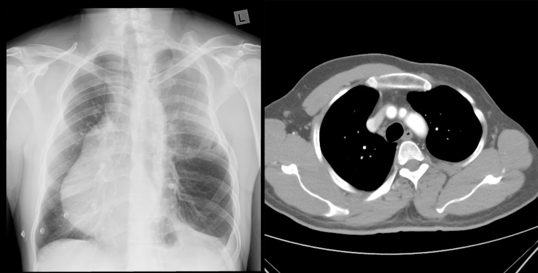 【病例】Poland综合征1例CT影像-4