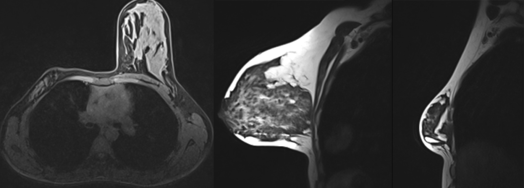【病例】Poland综合征1例CT影像-3