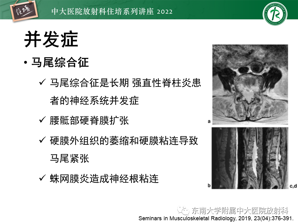 【PPT】脊柱关节炎影像学评估-28