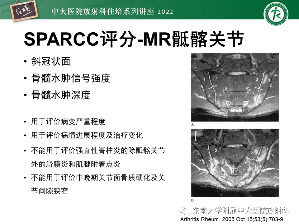 【PPT】脊柱关节炎影像学评估-23