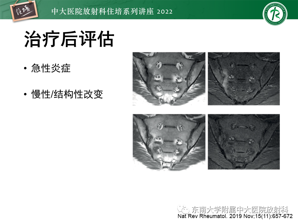 【PPT】脊柱关节炎影像学评估-25