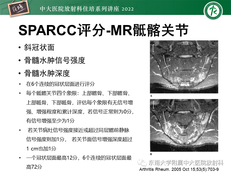 【PPT】脊柱关节炎影像学评估-22