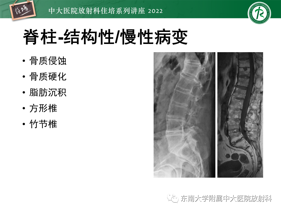 【PPT】脊柱关节炎影像学评估-18