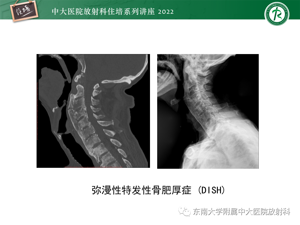 【PPT】脊柱关节炎影像学评估-34