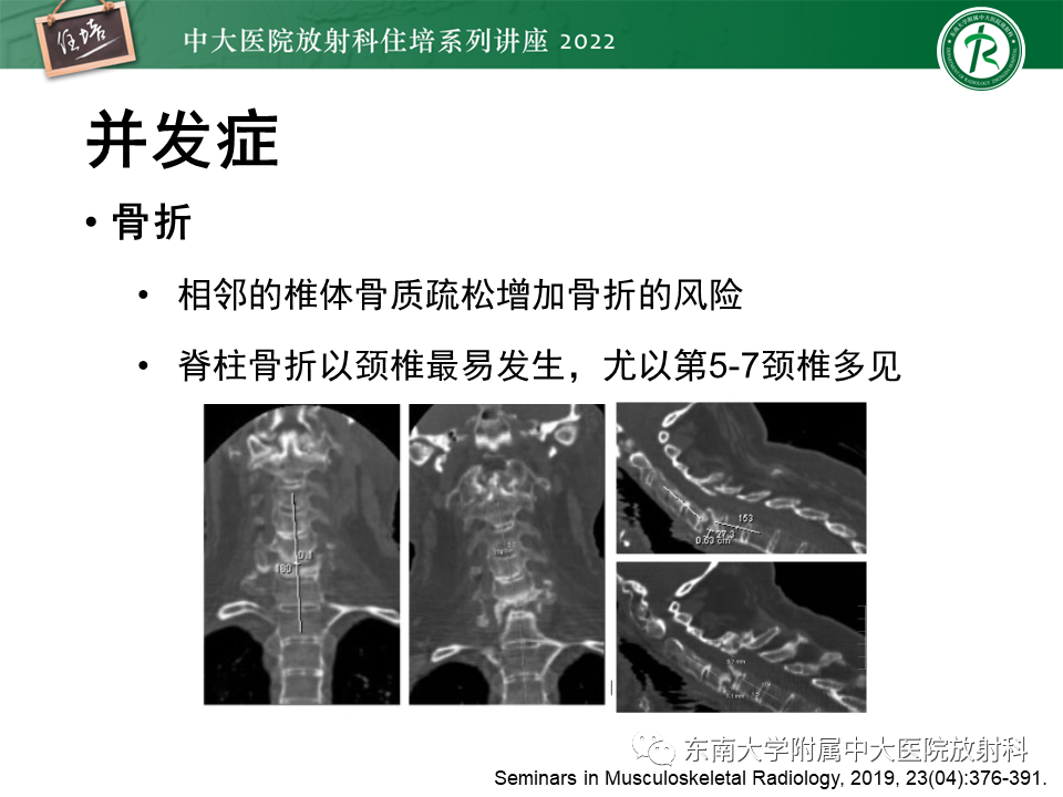 【PPT】脊柱关节炎影像学评估-27