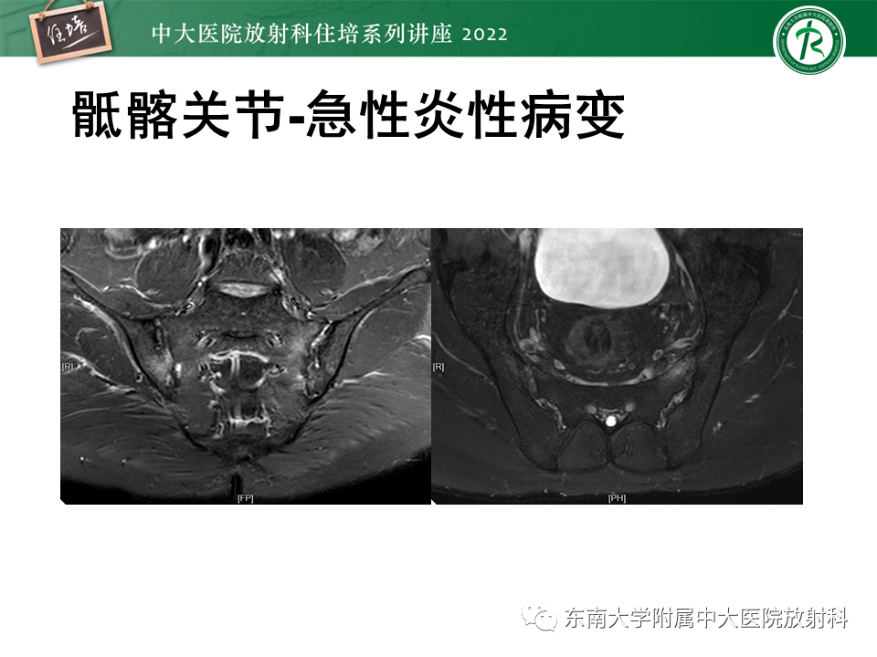 【PPT】脊柱关节炎影像学评估-10