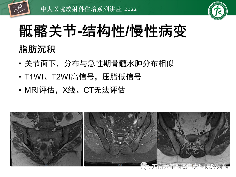 【PPT】脊柱关节炎影像学评估-13