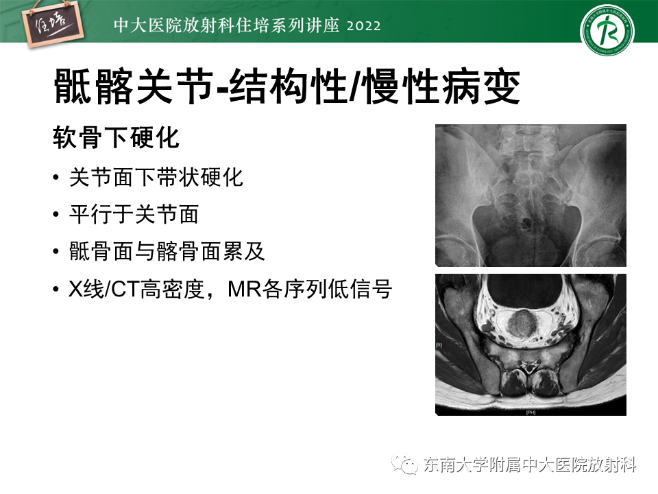 【PPT】脊柱关节炎影像学评估-11