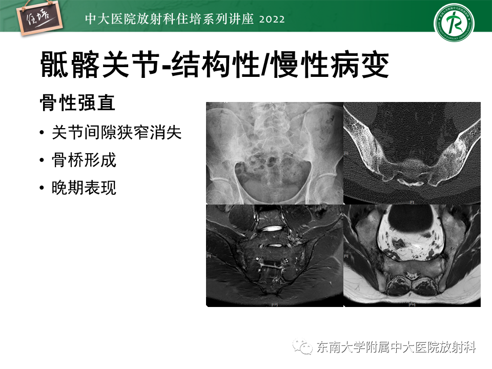 【PPT】脊柱关节炎影像学评估-14