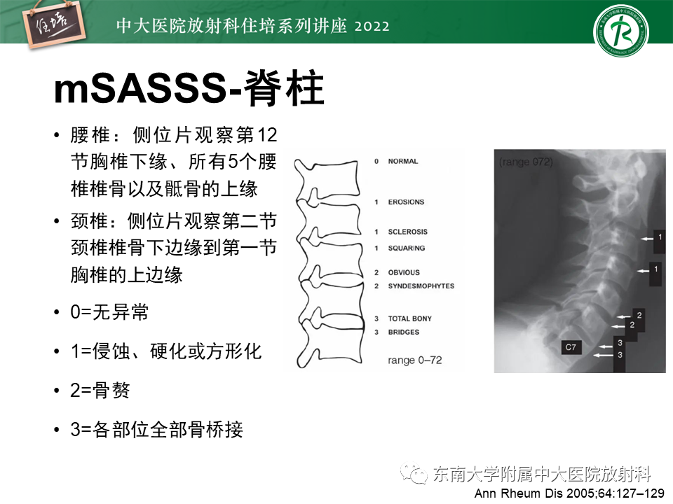 【PPT】脊柱关节炎影像学评估-21