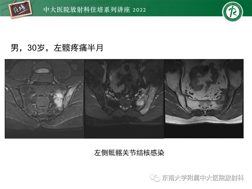 【PPT】脊柱关节炎影像学评估-32