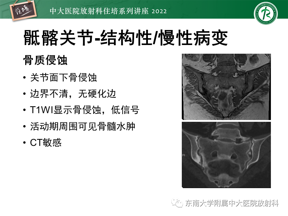 【PPT】脊柱关节炎影像学评估-12