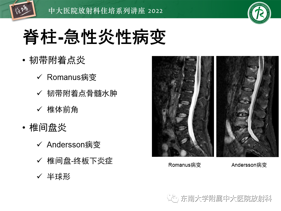 【PPT】脊柱关节炎影像学评估-16