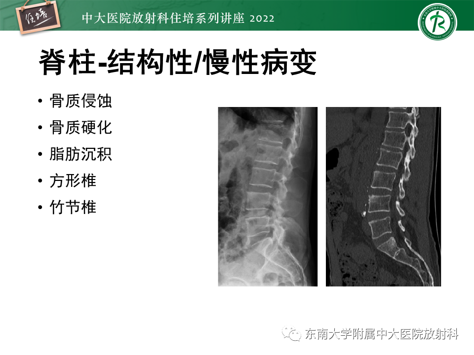 【PPT】脊柱关节炎影像学评估-17