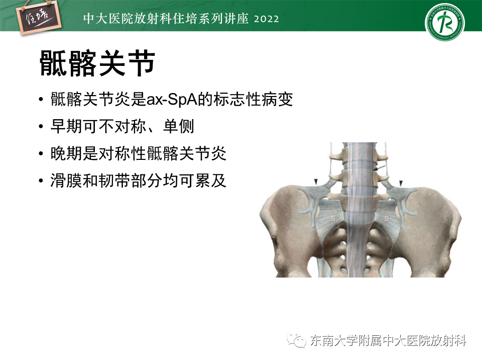 【PPT】脊柱关节炎影像学评估-8