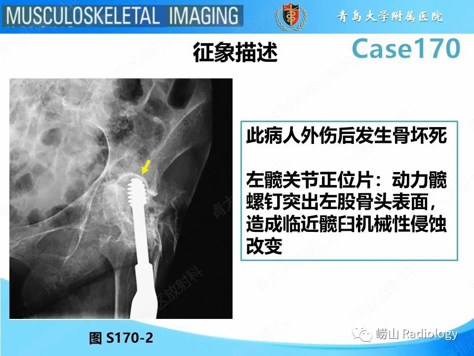 【PPT】股骨术后并发症-12