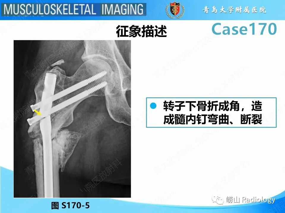 【PPT】股骨术后并发症-15