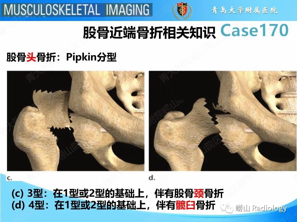 【PPT】股骨术后并发症-20