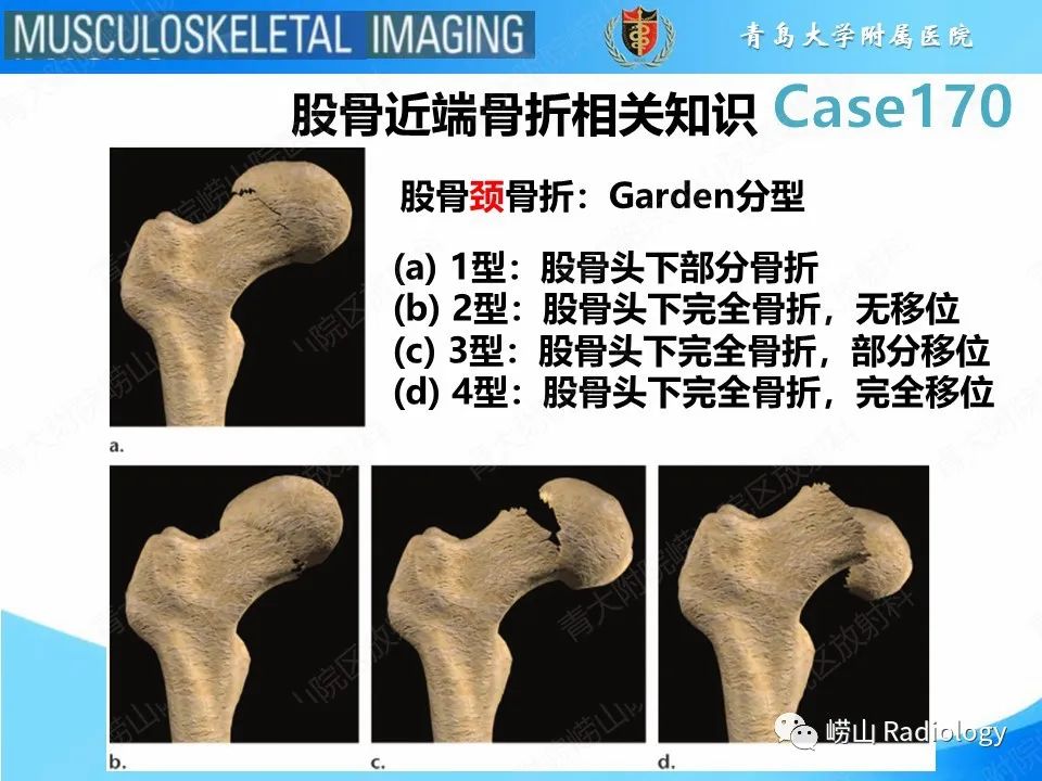 【PPT】股骨术后并发症-21