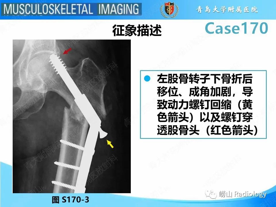【PPT】股骨术后并发症-13
